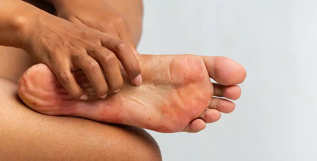 Consejos para prevenir los hongos de los pies en verano