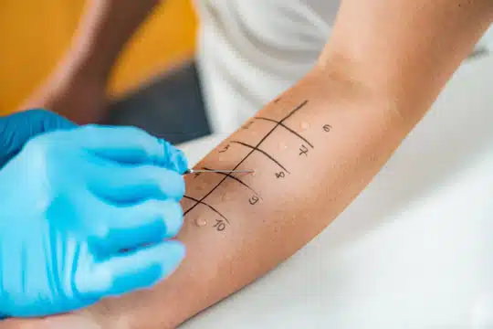 prueba de alergia prueba de alergia