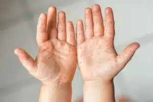 Enfermedad de mano, pie y boca: Síntomas, contagio y cómo prevenirla