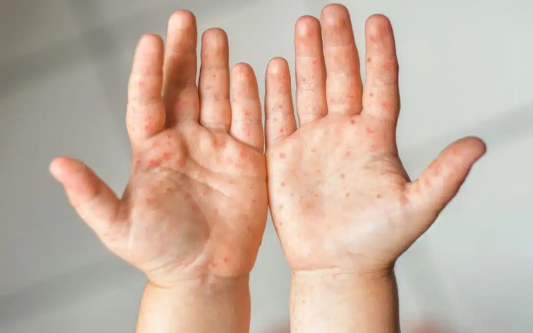 Enfermedad de mano, pie y boca: Síntomas, contagio y cómo prevenirla