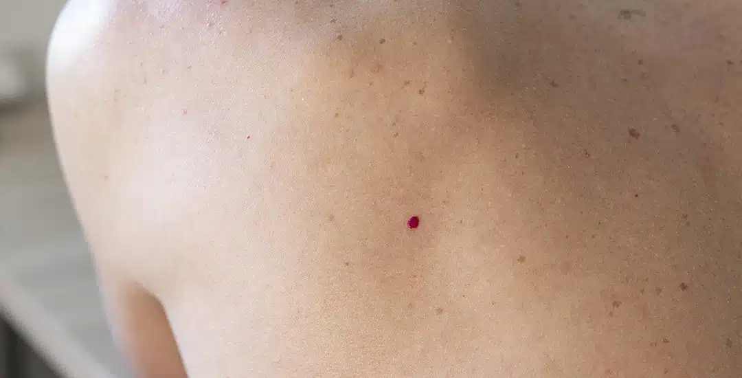 Lunares rojos en la piel: ¿Por qué aparecen?
