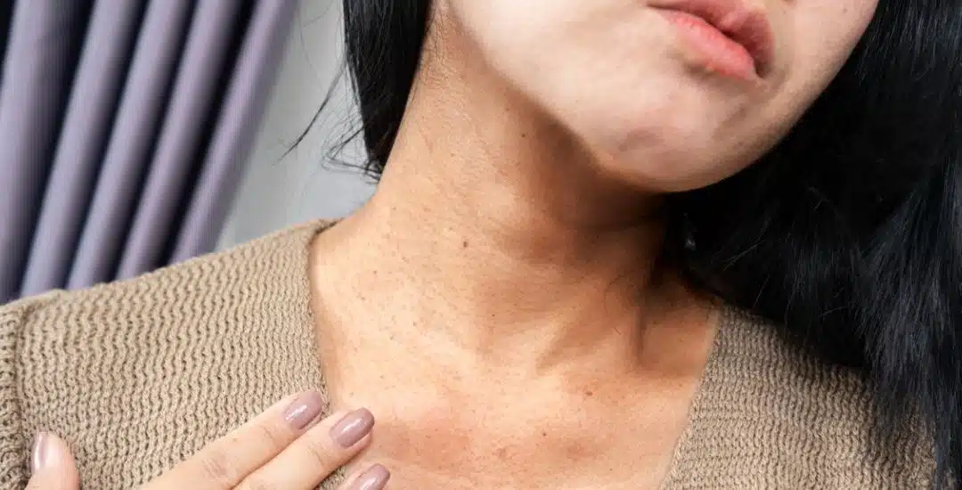 Lo que debes saber sobre las manchas blancas en la piel