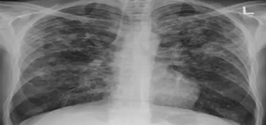 Fibrosis Pulmonar: causas, síntomas y tratamientos | ¿Es contagiosa y tiene cura?
