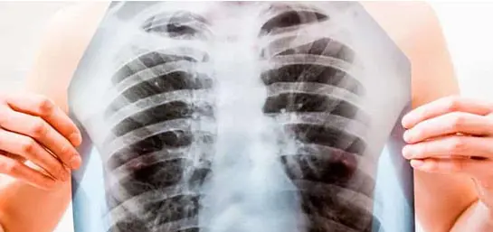tuberculosis-una-enfermedad-que-todavia-no-se-puede-erradicar