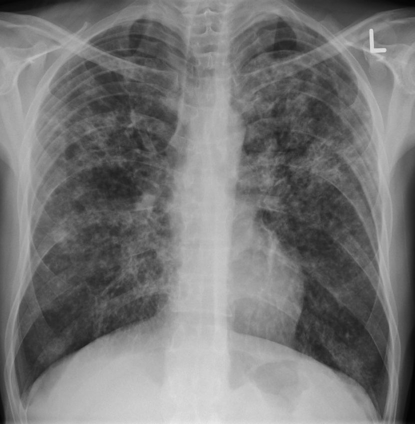 Fibrosis Pulmonar: causas, síntomas y más | Blog MAPFRE diagram pulmonary disease 