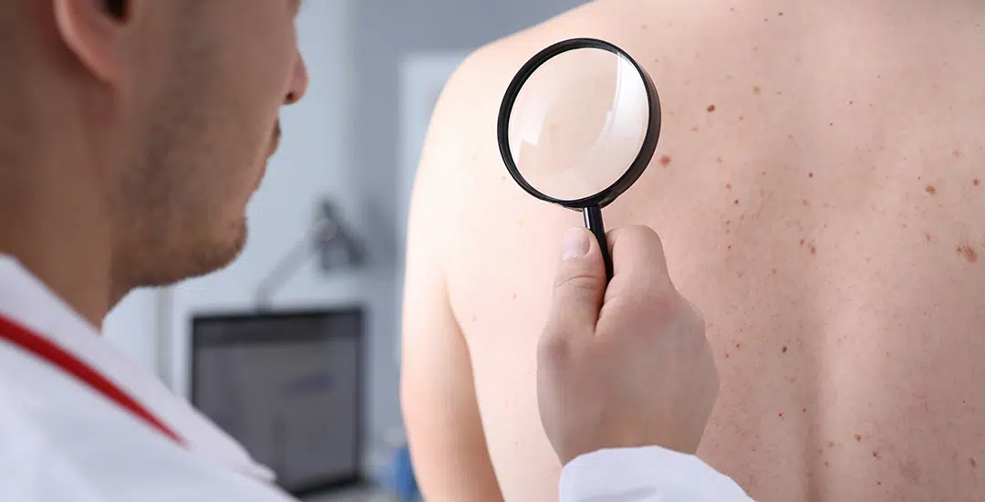 ¿Cómo detectar el cáncer de piel?